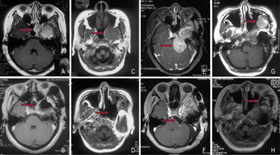 Case Report: Identification of a Novel GNAS Mutation and 1p/22q Co-Deletion in a Patient With Multiple Recurrent Meningiomas Sensitive to Sunitinib